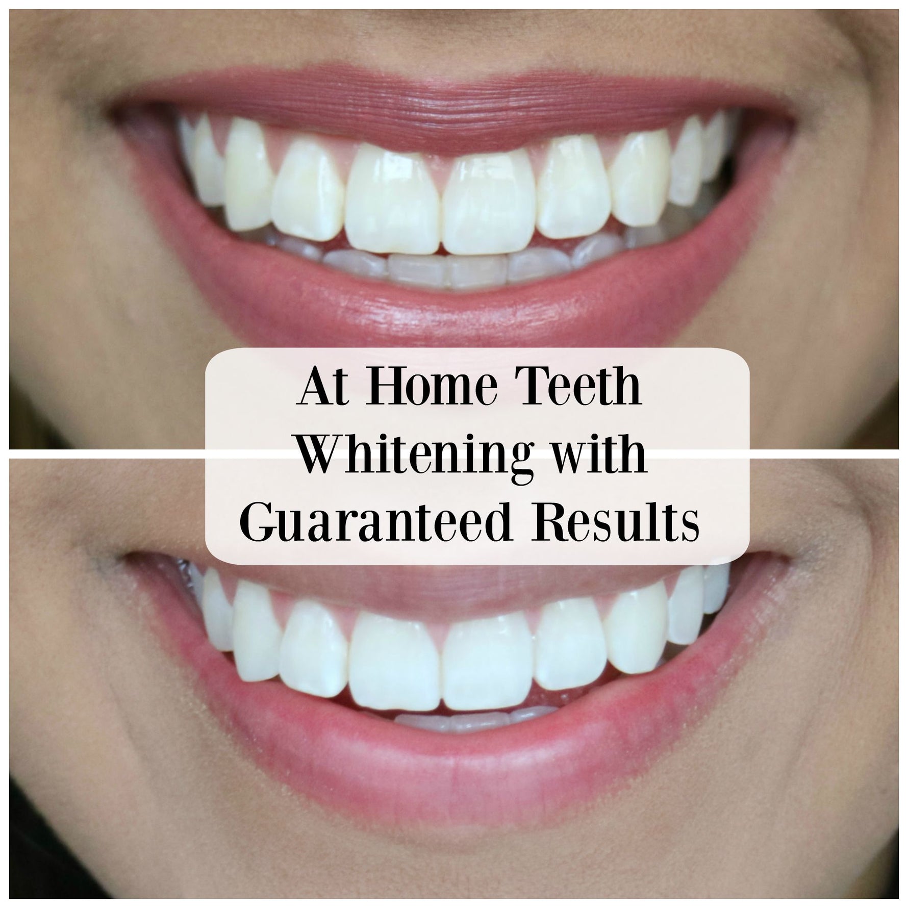 POLA Light At Home Teeth Whitening System - Go Oral Care